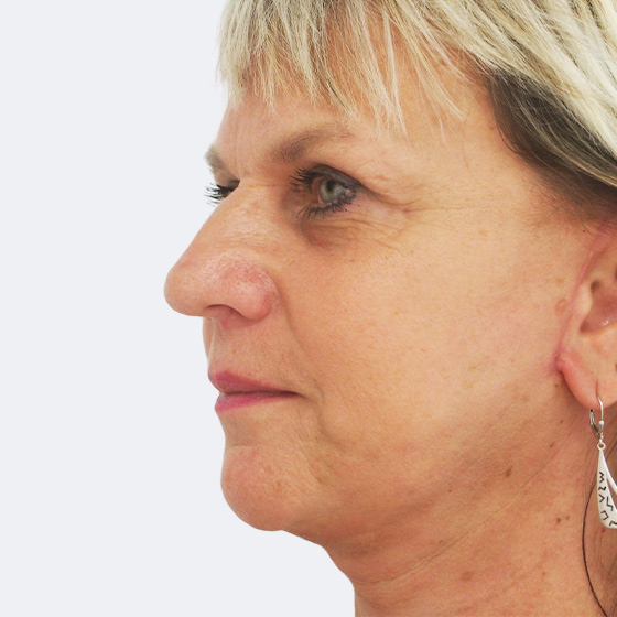 Facelift s liposukcí podbradku – po