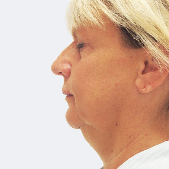 Facelift s liposukcí podbradku – před