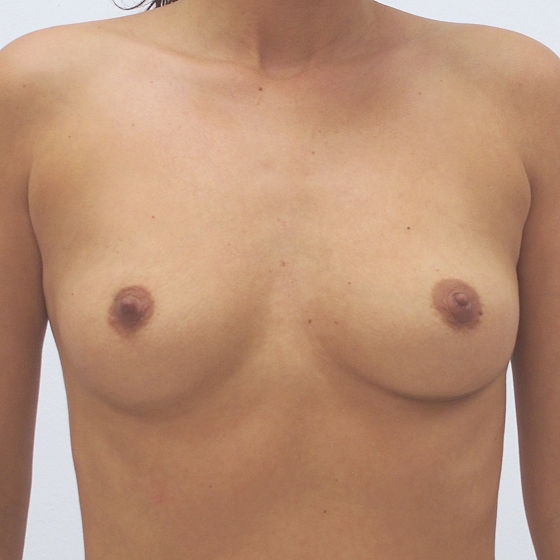 Zvětšení prsou implantáty – před