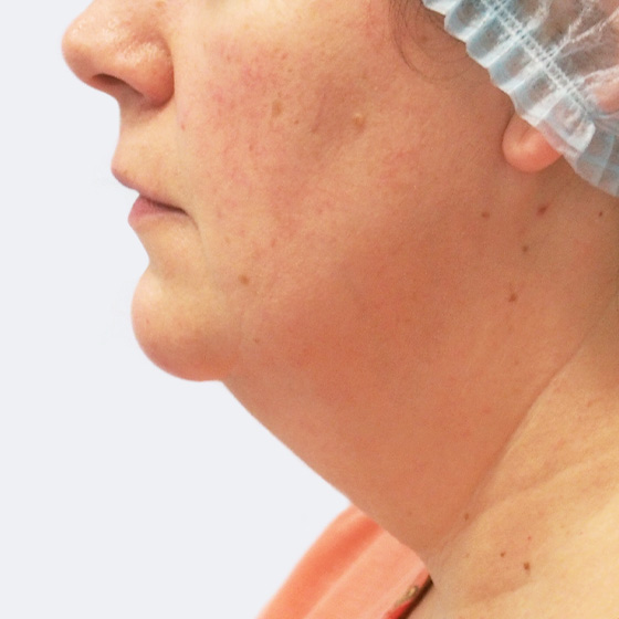 Liposukce podbradku – před