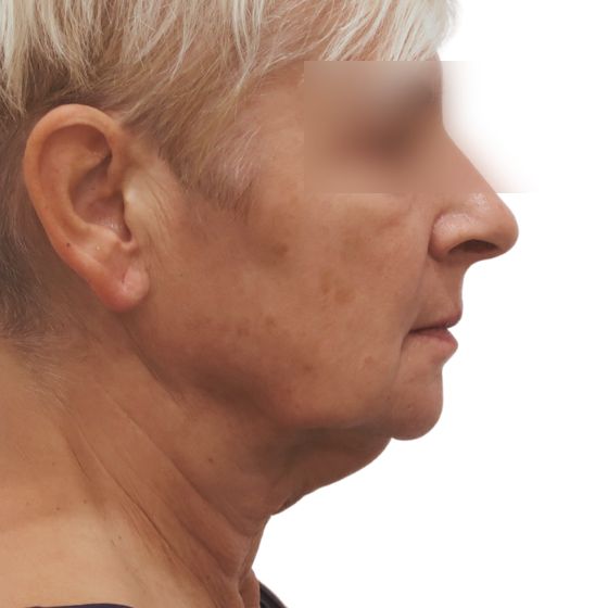 Facelift (SMAS) – před