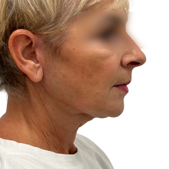 Facelift (SMAS) – po
