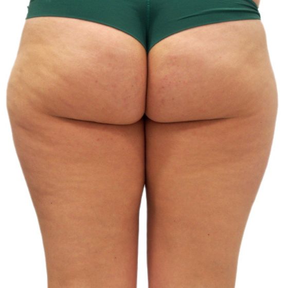 Liposukce vnějších stehen – před