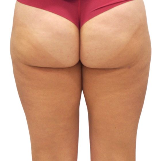 Liposukce vnějších stehen – po