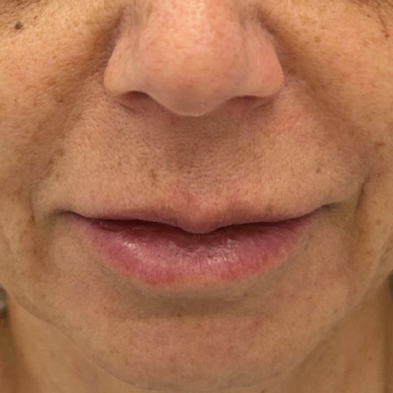 Lip lift – před