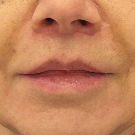 Lip lift – po
